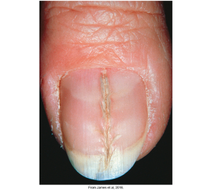 NURS 6512 Differential Diagnosis for Skin Conditions Paper